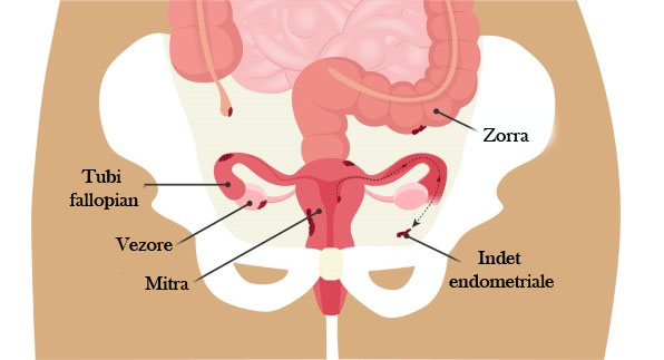 Endometrioza